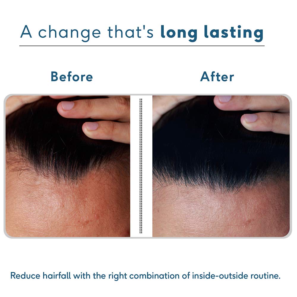 6 - HealthKart HK Vitals Anti-Hairfall Kit (for Men), 3 Piece(s)/Pack Combo