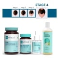 Hair Fall Solution, STAGE 4