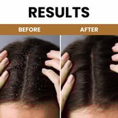 4 - myUpchar Ayurveda Kesh Art Bhringraj Shampoo,  200 ml  Anti-Dandruff 